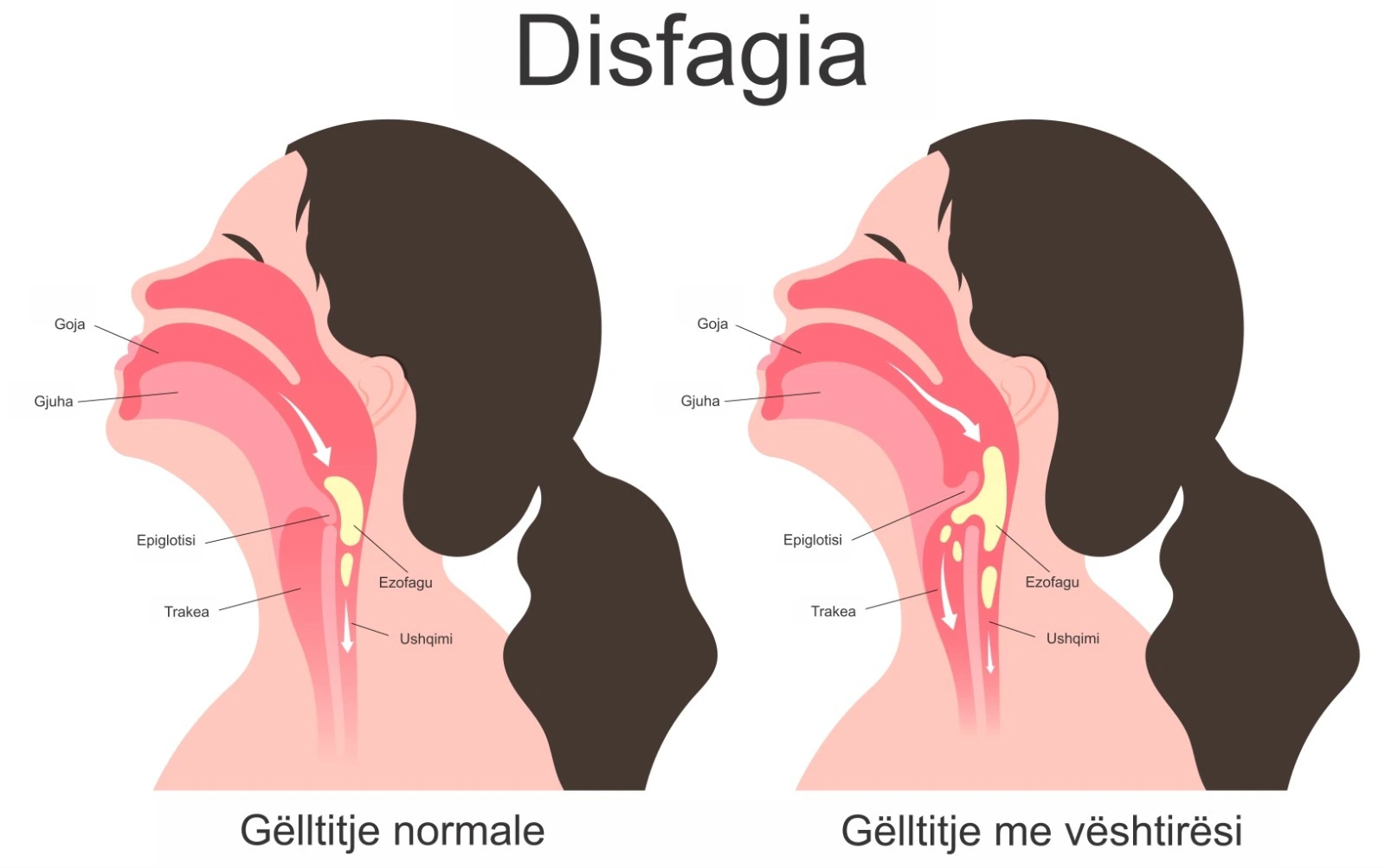 Diagram që krahason gëlltitjen normale me disfaginë, ku ushqimi kalon me vështirësi në ezofag.