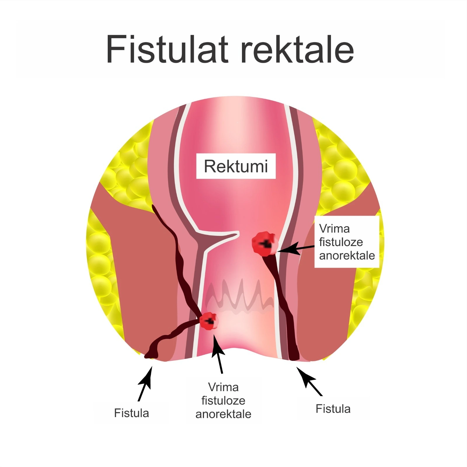 Diagram që tregon fistulat rektale dhe kanalet fistuloze rreth rektumit.