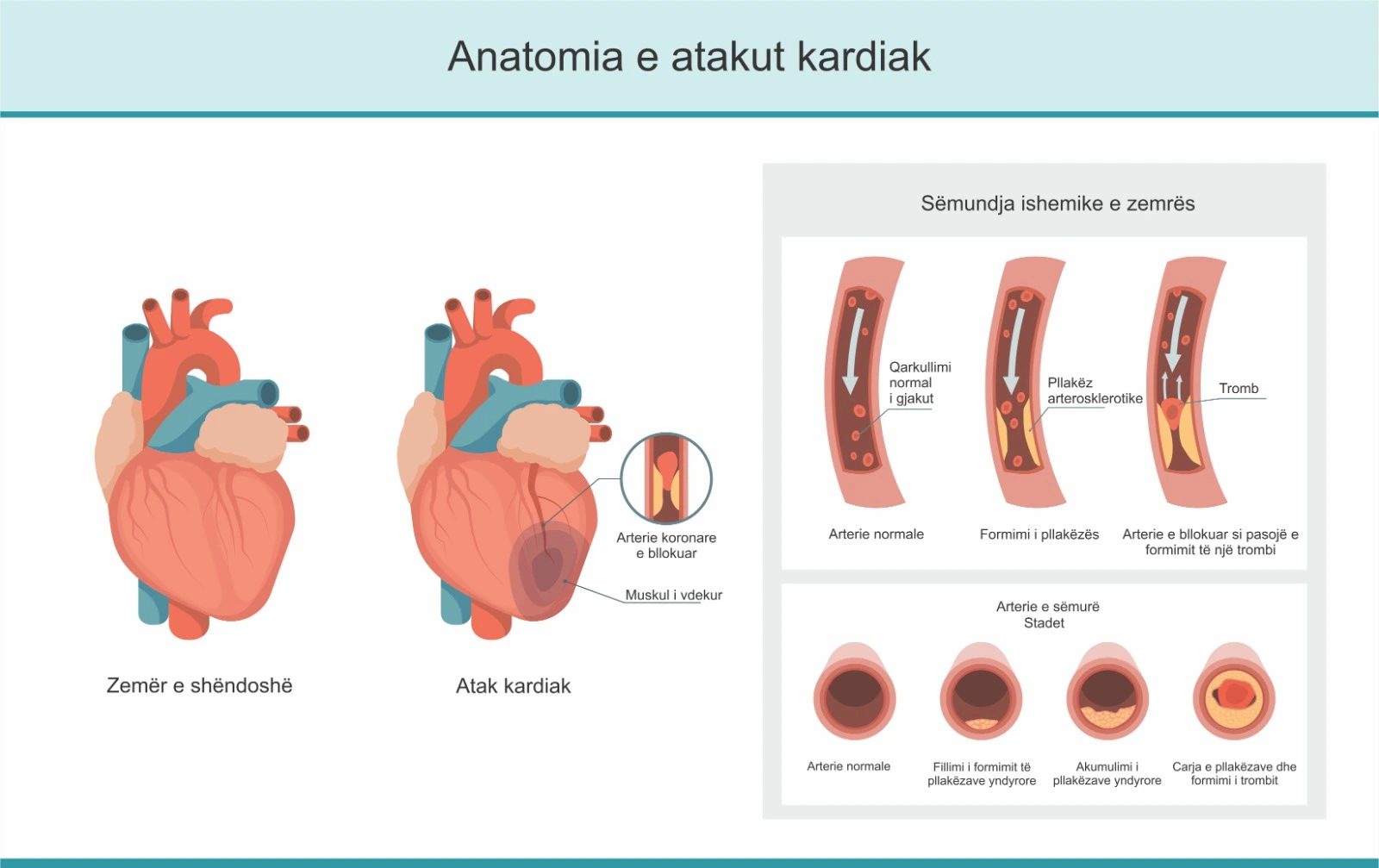 Diagram që paraqet anatominë e atakut kardiak, duke krahasuar zemrën e shëndoshë me zemrën gjatë infarktit, ku arteriet koronare bllokohen nga pllaka aterosklerotike dhe trombi, duke shkaktuar dëmtim të muskulit të zemrës.