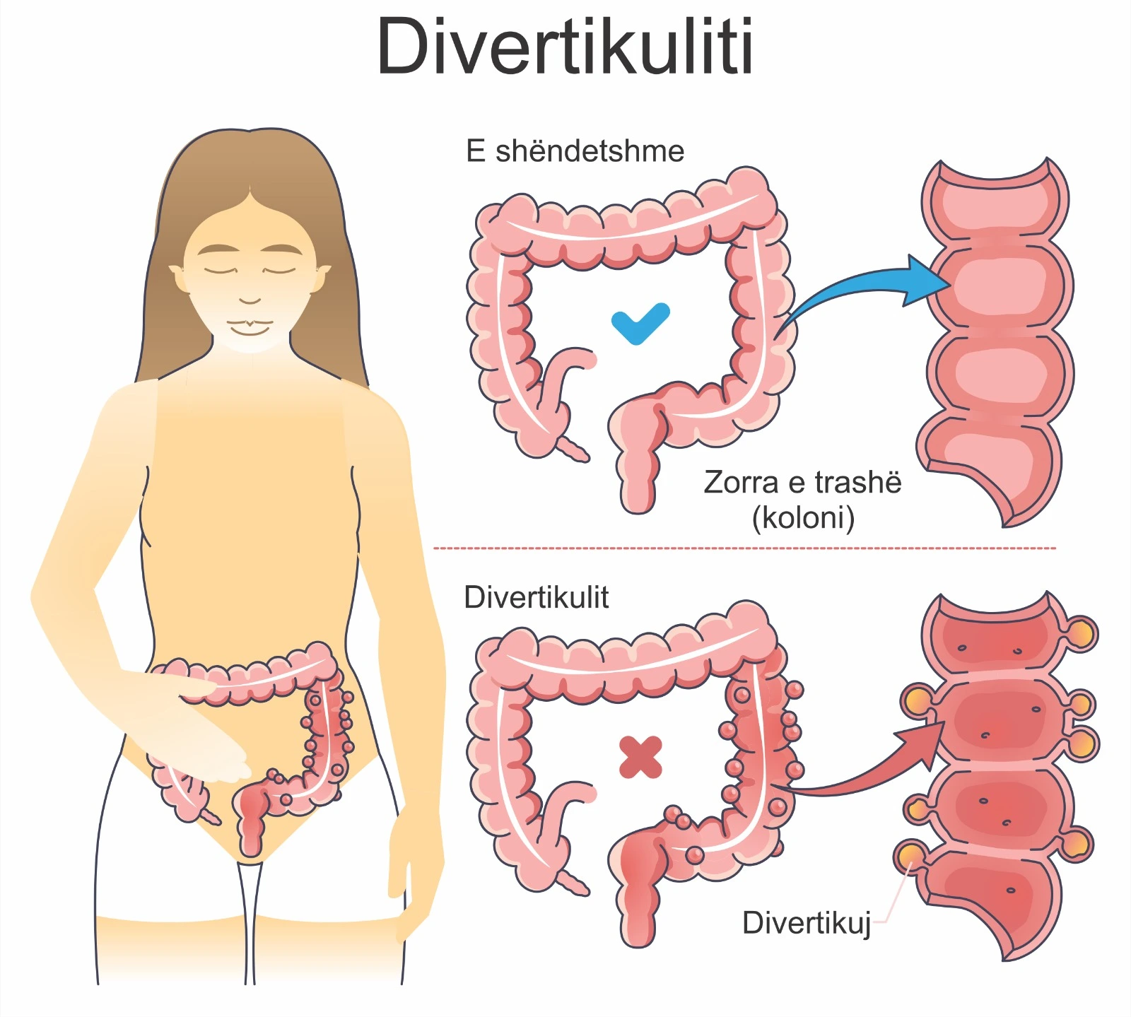 Diagram i zorrës së trashë që tregon divertikulat dhe inflamacionin në divertikulit