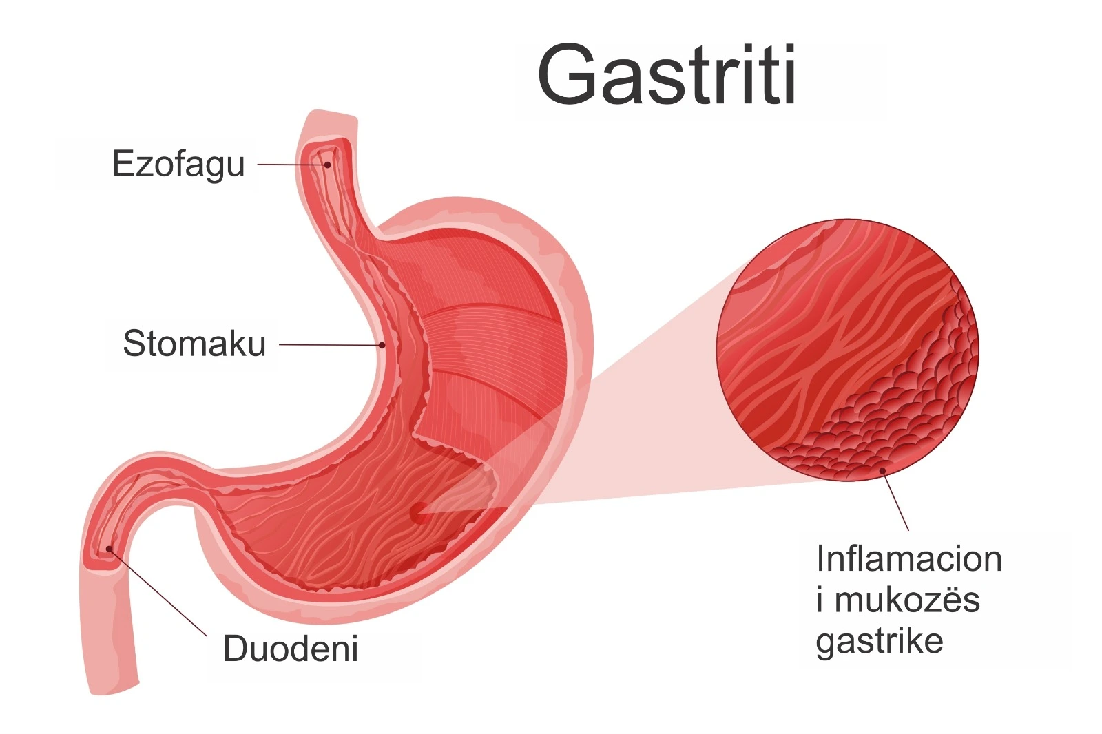 Diagram i stomakut që tregon inflamacionin e mukozës gastrike.