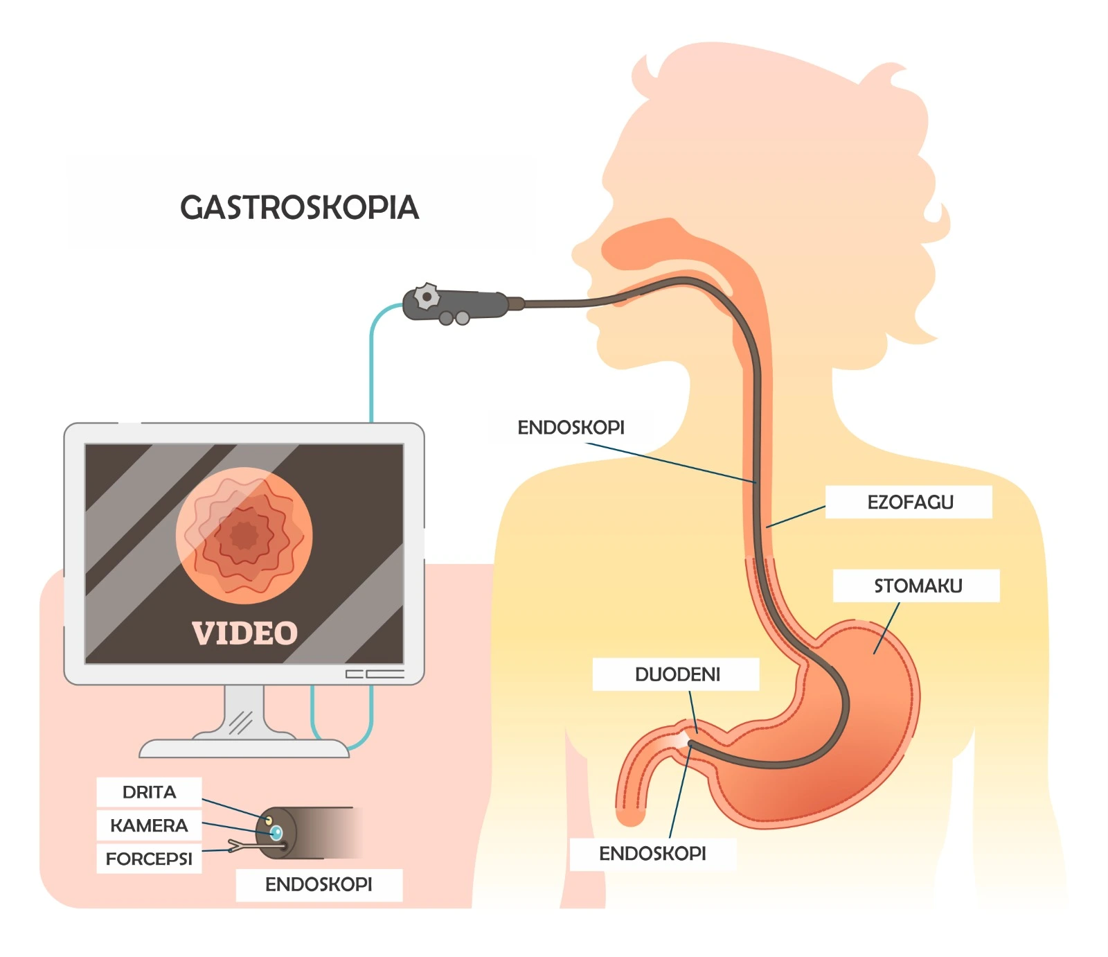 Diagram qe tregon si kryhet gastroskopia me endoskop
