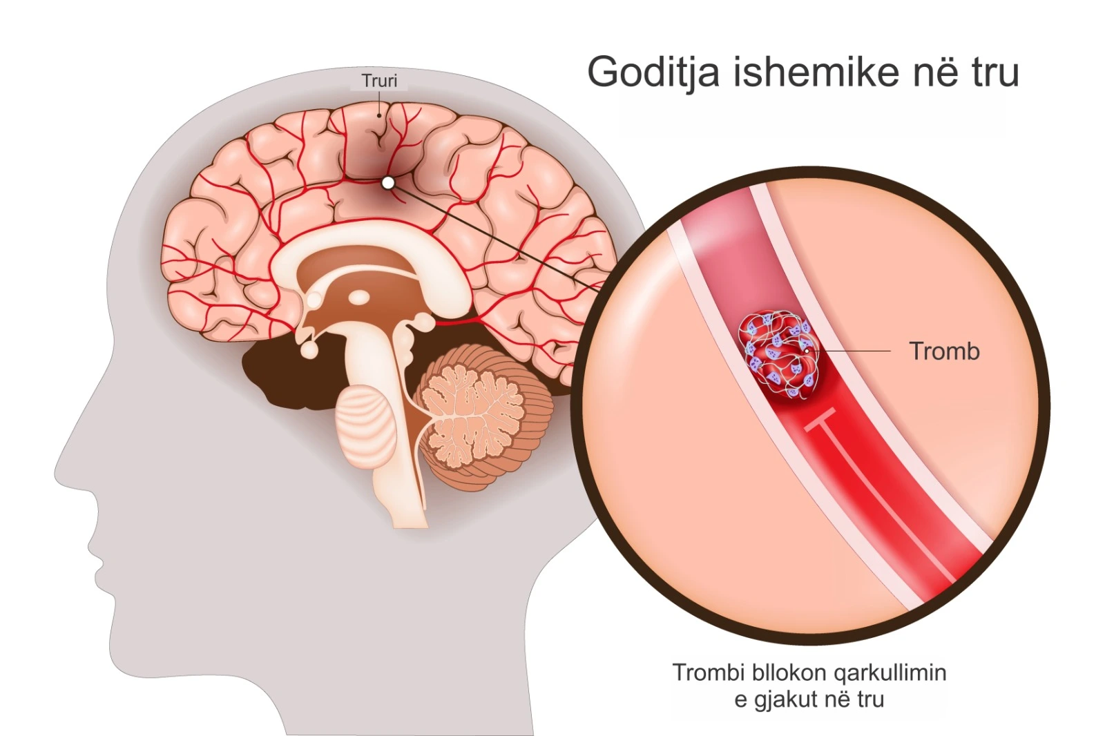 Diagram që paraqet goditjen ishemike në tru, ku një tromb bllokon qarkullimin e gjakut në enët e trurit dhe pengon furnizimin me oksigjen.