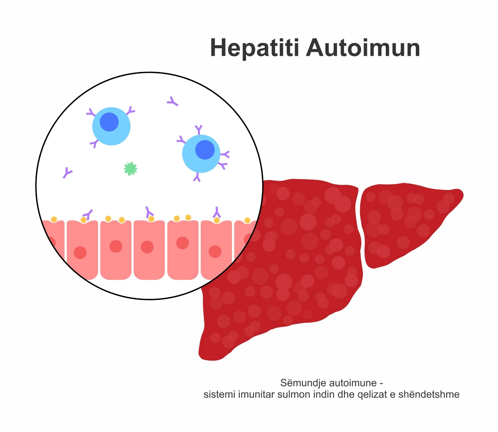 Diagram që tregon hepatitin autoimun, ku sistemi imunitar sulmon qelizat e shëndetshme të mëlçisë duke shkaktuar inflamacion dhe dëmtim të mëlçisë.
