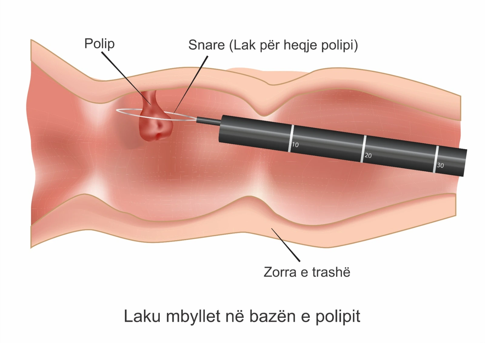 Diagram që tregon heqjen e një polipi në zorrën e trashë gjatë kolonoskopisë
