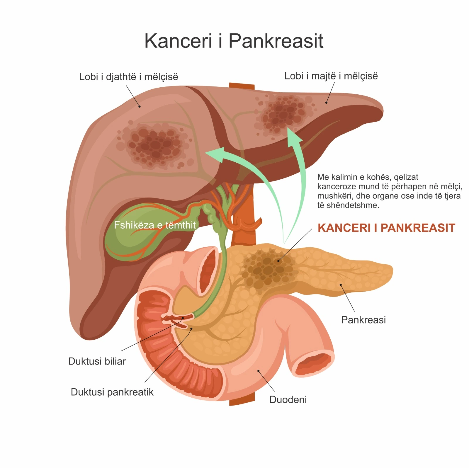 Diagram qe tregon kancerin e pankreasit