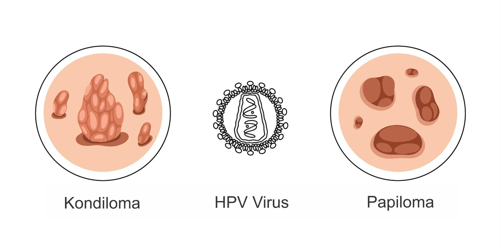 Diagram që paraqet virusin HPV dhe ndryshimet e lëkurës si kondiloma dhe papiloma.