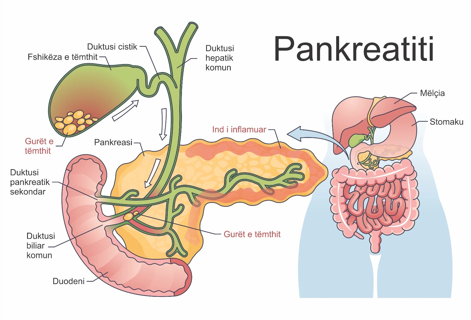 Diagram i pankreasit që tregon inflamacionin në pankreatit dhe lidhjen me gurët e tëmthit dhe kanalet biliare