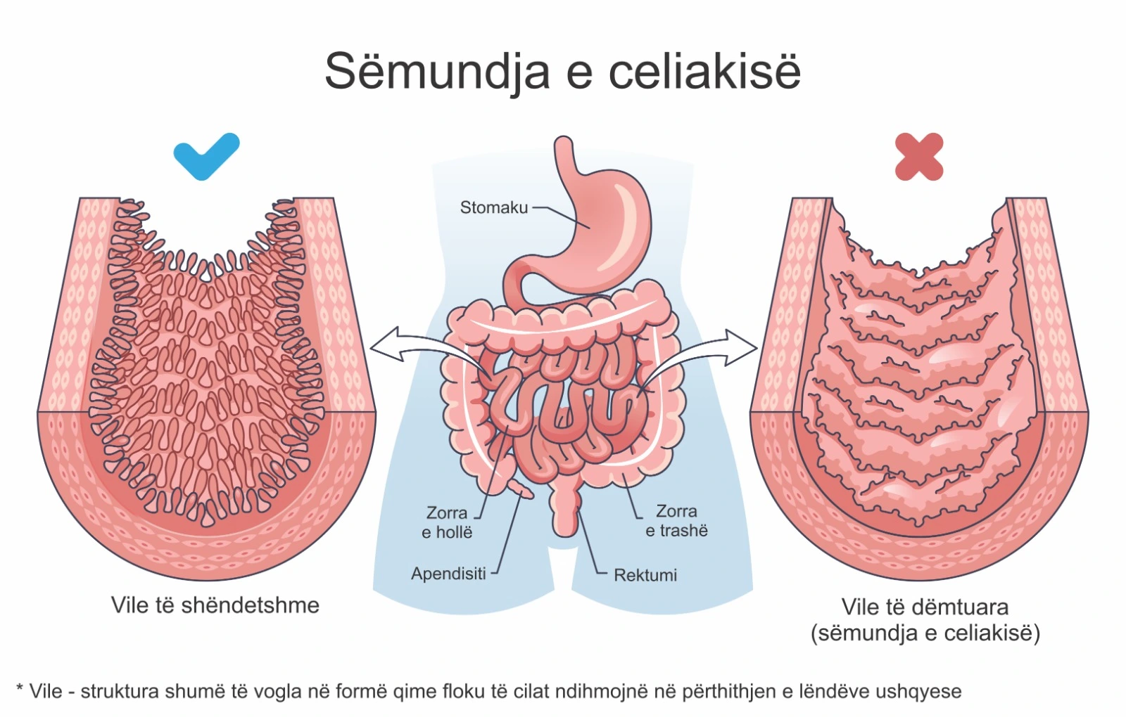 Diagram që ilustron sëmundjen e celiakisë, duke krahasuar vile të shëndetshme të zorrës së hollë me vile të dëmtuara, si dhe ndikimin në sistemin tretës (stomak, zorrë e hollë dhe e trashë)