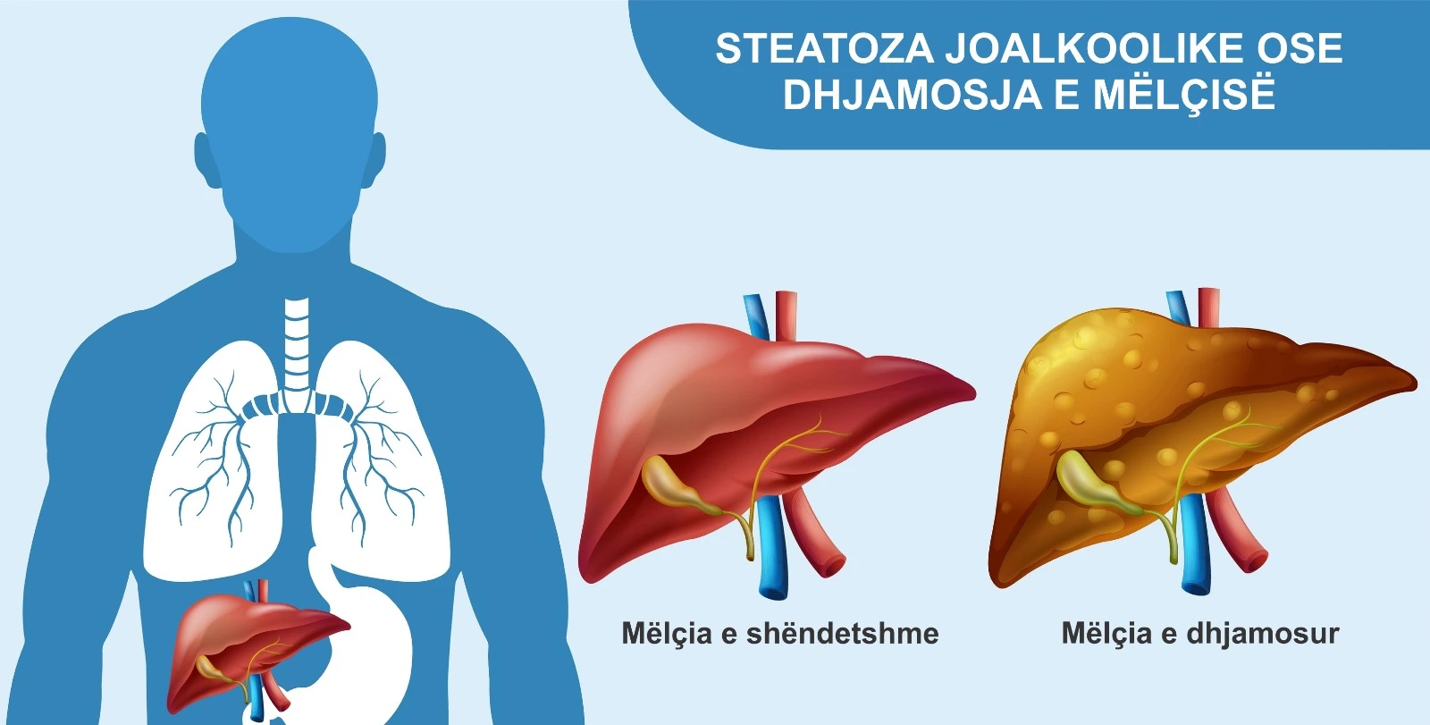 Diagram që krahason mëlçinë e shëndetshme me mëlçinë e dhjamosur në steatozën joalkoolike.