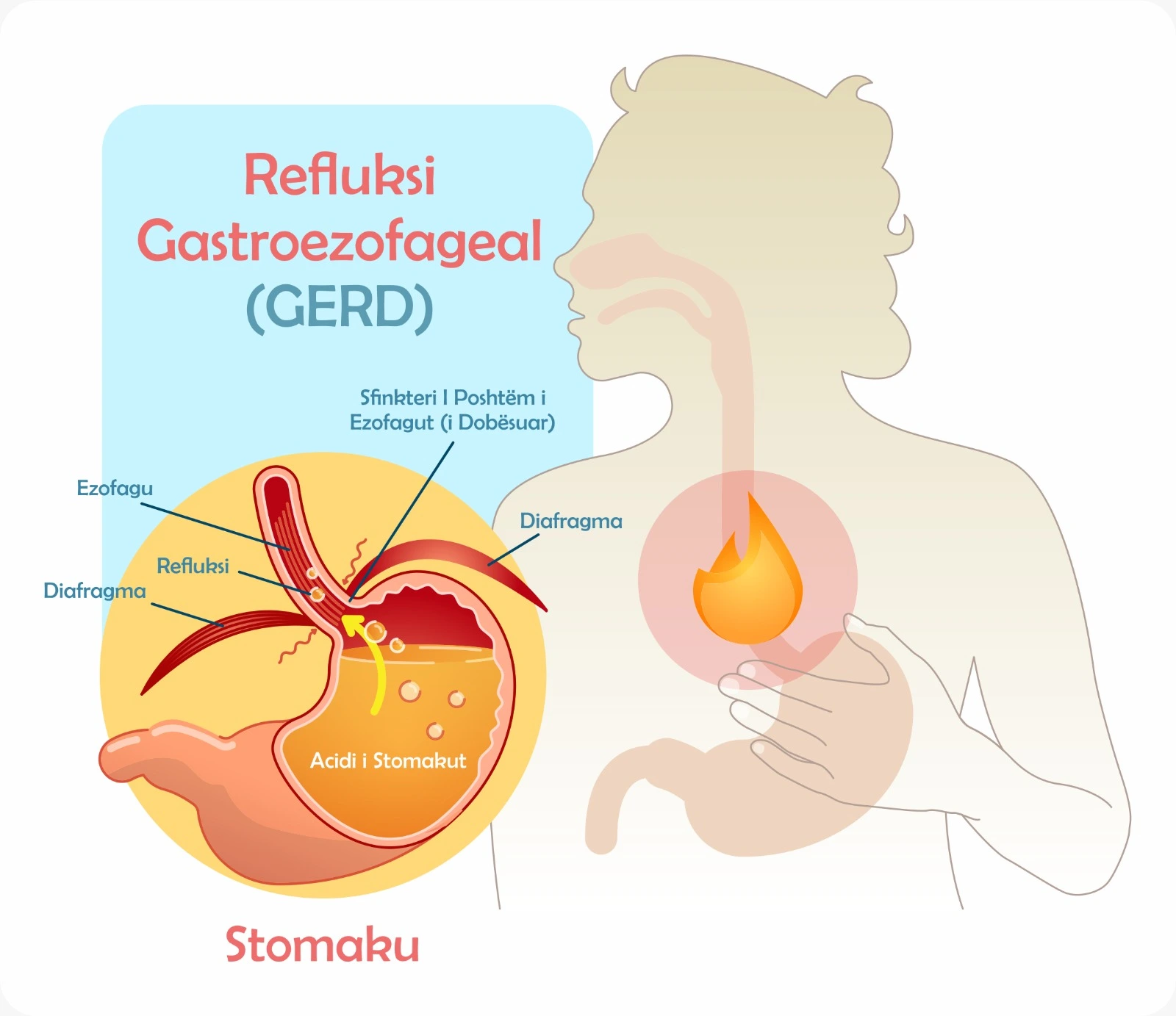 Diagram qe shpjegon refluksin gastroezofageal (GERD) dhe kthimin e acidit nga stomaku ne ezofag